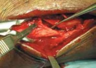 Illustration 17 for Optimal Fixation of the Ankle: Open Reduction & Internal Fixation