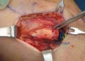 Illustration of chronic knee medial - Dr. Mohammed Hutaif