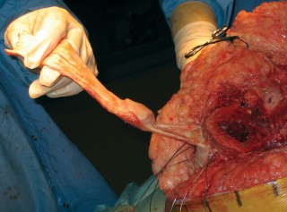 Illustration 15 for Extensor Reconstruction in Total Knee Arthroplasty: Essential Strategies