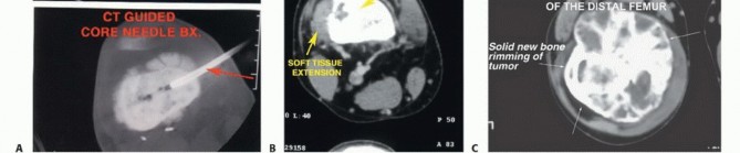 Illustration 22 for Advanced Distal Femoral Resections: Limb-Sparing Outcomes & Techniques