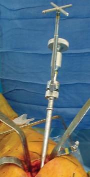 Illustration 34 for Mastering the Cementless Acetabular Cup: Techniques for Optimal Fixation