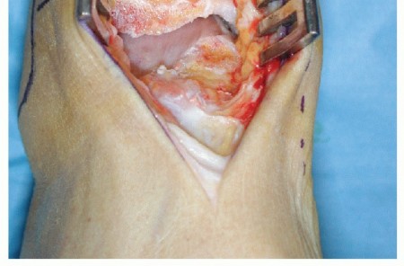 Illustration 10 for HINTEGRA Total Ankle: Unlocking Natural Ankle Movement