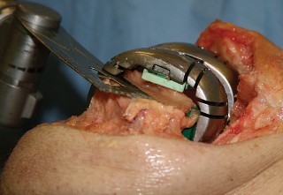 Illustration 11 for Understand Augments: The Role of Metal Augments in Arthroplasty