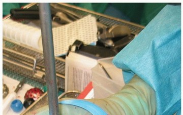 Illustration 5 for Cemented Acetabular Component: Achieving Optimal THA Stability