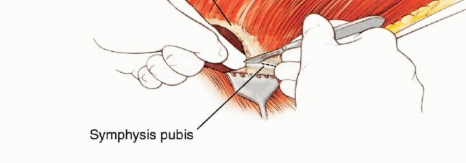 Illustration 29 for Anterior Flap Hemipelvectomy: Leveraging fig tech fig for Difficult Tumors