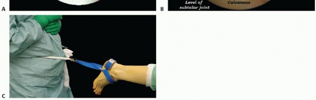 Illustration 13 for Posterior Talar Process: Endoscopic Solutions for Ankle Pain