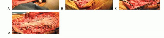 Illustration 14 for Patella Tendon Rupture Reconstruction in Revision TKA