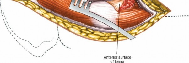 Illustration 110 for Unlocking Every Aspect of the Hip's Surgical Approaches