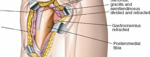 Illustration 22 for Surgical Access: Mastering the Tibia's Surface & Fibula Approaches