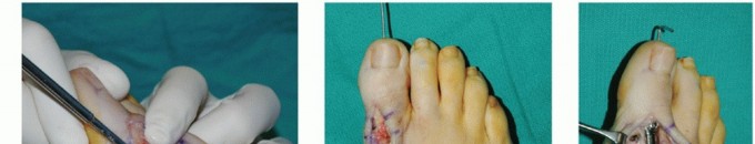 Illustration 23 for MTP Joint Arthrodesis: The Key to Optimal Toe Positioning