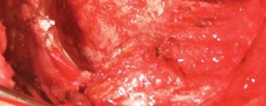 Illustration 6 for The Modified Hardinge Approach: Key Surgical Insights