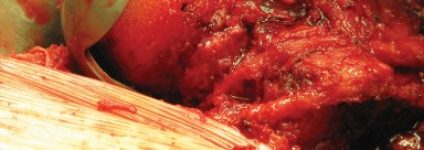 Illustration 52 for Figure Hip Resurfacing: Who Benefits and Who Should Avoid It?