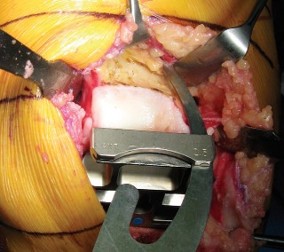 Illustration 14 for Minimally Invasive Subvastus: The Best Path to Quicker TKA Recovery