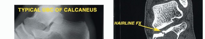 Illustration 11 for Treating Tumors of the Foot: Optimizing Amputation & Resection