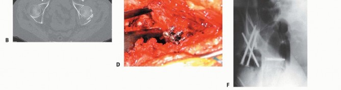 Illustration 15 for Regain Mobility: Total Hip Arthroplasty for Malignant Lesions