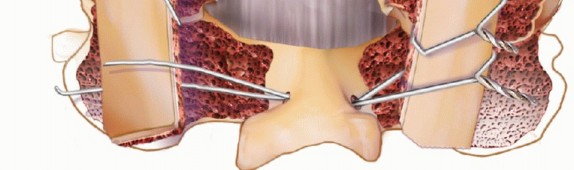 Illustration 18 for Achieve Stability: Posterior Cervical Lateral Mass Screw Fusion