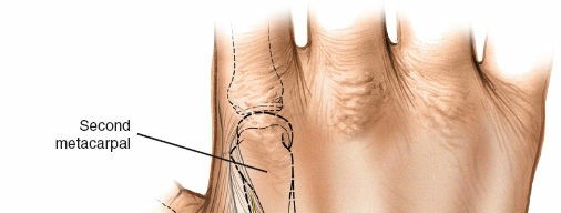 Illustration 9 for Key Approaches for External Fixation: Humerus, Radius, Ulna, Wrist