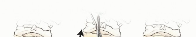 Illustration 36 for Master Techniques for Cervical Fracture Reduction: Type III & More