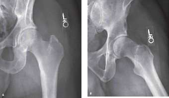 Illustration of predictors of fixation - Dr. Mohammed Hutaif