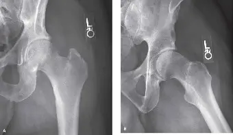 فشل تثبيت كسور الورك: الأسباب، الأعراض، العلاج، والوقاية مع الأستاذ الدكتور محمد هطيف