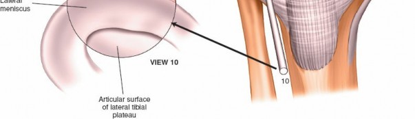 Illustration 27 for Mastering Knee Approaches: Spotlight on Superficial Medial Ligament