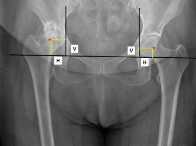 Illustration 6 for Maximize Success: Preoperative planning in primary Hip Replacement