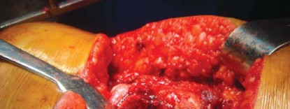 Illustration 34 for The Silent Hip: Achieving a Truly Silent, Pain-Free Joint