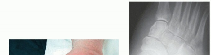 Illustration 12 for Regain Mobility: Surgical Solutions for Charcot Foot Arthropathy