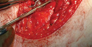 Illustration 65 for Unlock the Figure Posterior Approach to the Hip