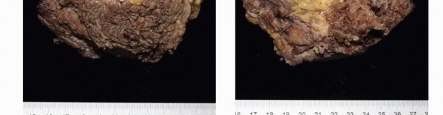 Illustration 60 for Sacral Tumor Surgery: Safeguarding Bowel & Bladder Control