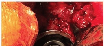 Illustration 8 for Mastering The Uncemented Socket: Ensure Lasting Hip Fixation