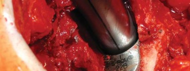 Illustration 29 for S-ROM: Inside the Technique of Modular Implant Design