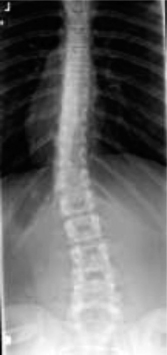 Pediatric Scoliosis: When Curves Are Larger Than Degrees, What's Next?
