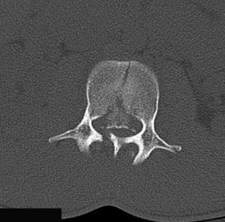 Illustration 20 for Adjacent Segment Degeneration: Your Next Spine Case Solved