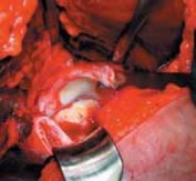 Illustration 28 for FAI: Impingement and Surgical Dislocation Explained