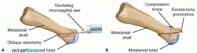 Illustration 16 for Toe Deformity Pain? Rebalance Flexor to Extensor for Relief