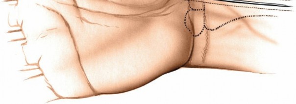 Illustration 3 for Volar Approach: Optimal Exposure for the Volar aspect of the Distal Radius