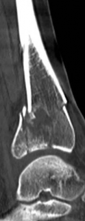 Illustration 11 for Decoding Pilon Fractures: Anterolateral and Medial Fragments Revealed
