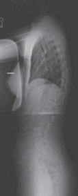 Illustration 3 for Mastering Anterior Interbody Arthrodesis with Instrumentation for Scoliosis