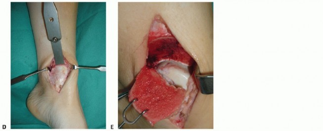 Illustration 13 for Painful Talus Lesions? The tech fig c Osteochondral Transfer Solution