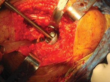 Illustration 21 for The Silent Hip: Achieving a Truly Silent, Pain-Free Joint