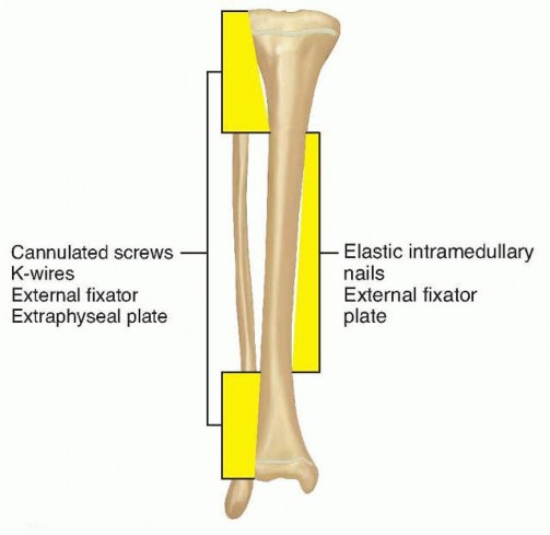 Illustration 4 for Optimal Treatment for Pediatric Tibial Fractures: Key Insights