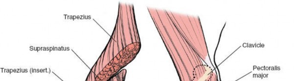 Illustration 7 for Deepen Skills: Anterolateral & Lateral Surgical Approaches