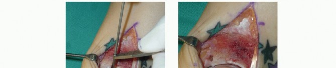 Illustration 18 for Unlock Healing: Medial Malleolar Osteotomy for Talus OLT Allografts