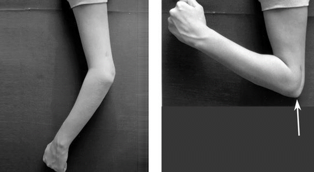 كسور الكوع (أوليكرانون)