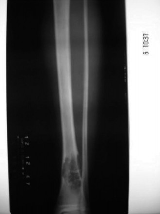 Unraveling Chondromyxoid Fibroma: An Oncology Case Study Guide