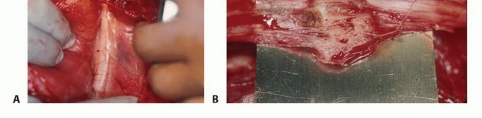 Illustration 21 for Precision Biopsy of Musculoskeletal Tumors for Accurate Diagnosis