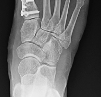 Illustration 3 for Medial Eminence Resection: Avoiding Hallux Varus & Recurrence