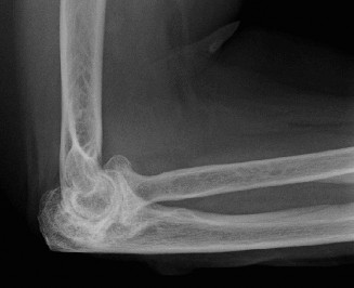 Illustration 80 for Right Shoulder Pain? Avoid This Common X-ray Mistake.