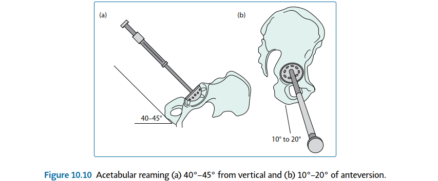Illustration 51 for Mastering Short External Rotators for Optimal Hip Surgery Results